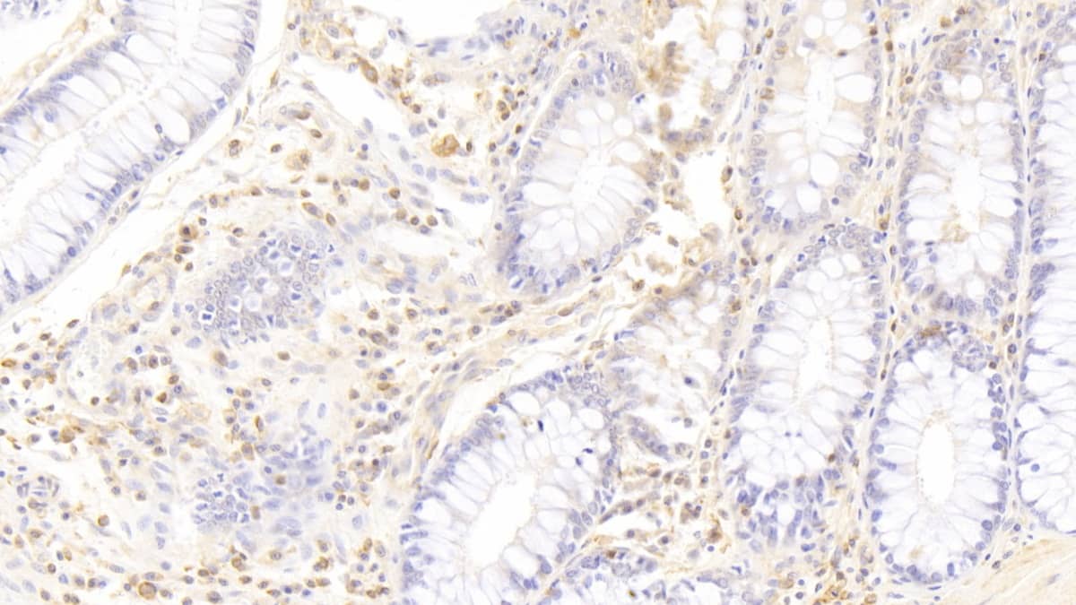 Immunohistochemistry-Paraffin: CD177 Antibody (C11) [NBP3-41085] - DAB staining on IHC-P; Sample: Human Colon Tissue; Primary Ab: 30ug/ml NBP3-41085; Second Ab: 2ug/mL HRP-Linked Caprine Anti-Mouse IgG Polyclonal Antibody