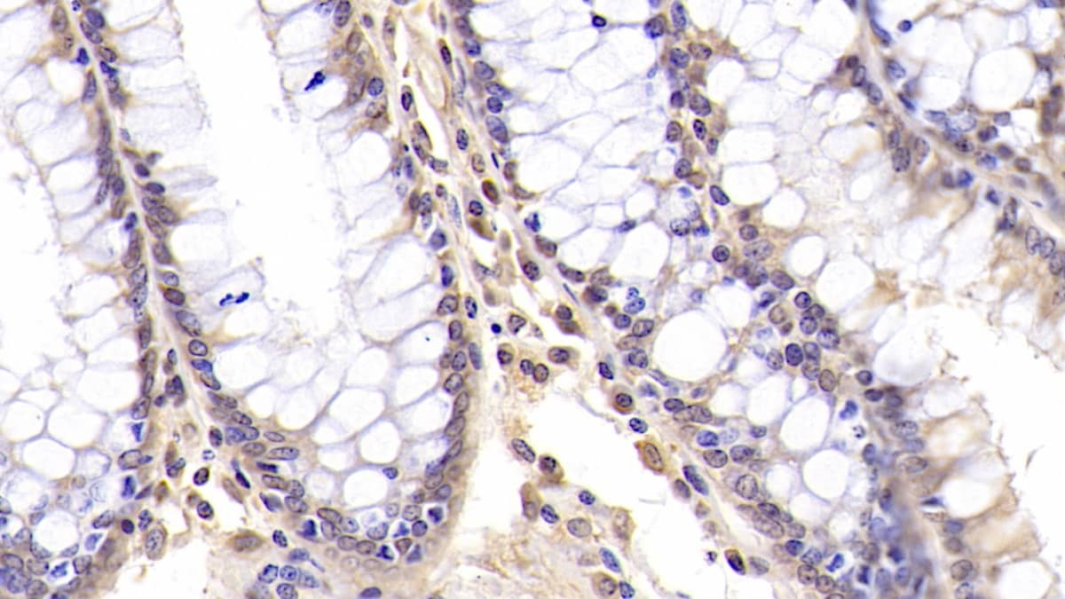 Immunohistochemistry-Paraffin: CD177 Antibody (C3) [NBP3-41086] - DAB staining on IHC-P; Sample: Human Colon Tissue; Primary Ab: 20ug/ml NBP3-41086; Second Ab: 2ug/mL HRP-Linked Caprine Anti-Mouse IgG Polyclonal Antibody