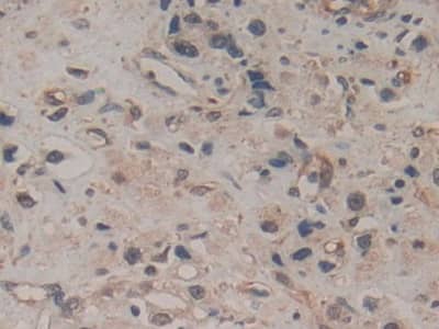 Immunohistochemistry-Paraffin: Amphiregulin Antibody (A7) [NBP3-41091] - DAB staining on IHC-P; Sample: Human Prostate cancer Tissue; Primary Ab: 20ug/ml NBP3-41091; Second Ab: 2ug/mL HRP-Linked Caprine Anti-Mouse IgG Polyclonal Antibody