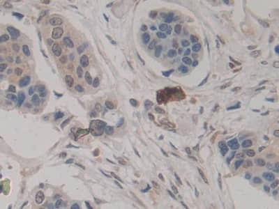 Immunohistochemistry-Paraffin: Amphiregulin Antibody (A7) [NBP3-41091] - DAB staining on IHC-P; Sample: Human Breast cancer Tissue; Primary Ab: 20ug/ml NBP3-41091; Second Ab: 2ug/mL HRP-Linked Caprine Anti-Mouse IgG Polyclonal Antibody