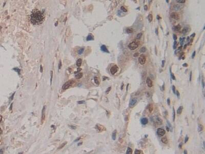 Immunohistochemistry-Paraffin: Amphiregulin Antibody (A7) [NBP3-41091] - DAB staining on IHC-P; Sample: Human Pancreatic cancer Tissue; Primary Ab: 20ug/ml NBP3-41091; Second Ab: 2ug/mL HRP-Linked Caprine Anti-Mouse IgG Polyclonal Antibody
