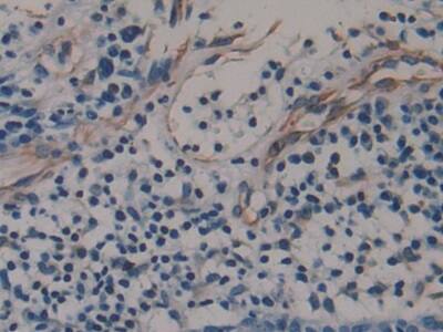 Immunohistochemistry-Paraffin: Amphiregulin Antibody (A2) [NBP3-41096] - DAB staining on IHC-P; Sample: Human Skin cancer Tissue; Primary Ab: 20ug/ml NBP3-41096; Second Ab: 2ug/mL HRP-Linked Caprine Anti-Mouse IgG Polyclonal Antibody