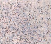 Immunohistochemistry-Paraffin: Amylin Antibody (C2) [NBP3-41139] - DAB staining on IHC-P; Samples: Human Rectum Cancer Tissue.