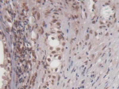 Immunohistochemistry-Paraffin: EGR1 Antibody (C11) [NBP3-41149] - DAB staining on IHC-P; Samples: Human Prostate Tissue; Primary Ab: 20ug/ml NBP3-41149; Second Ab: 2ug/mL HRP-Linked Caprine Anti-Mouse IgG Polyclonal Antibody