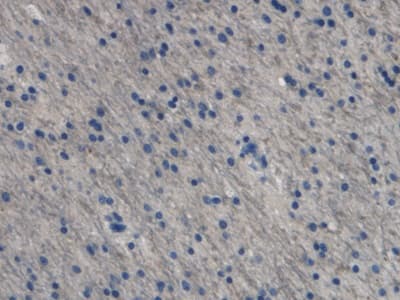 Immunohistochemistry-Paraffin: Endothelin-1 Antibody (C10) [NBP3-41151] - DAB staining on IHC-P; Samples: Human Glioma Tissue; Primary Ab: 20ug/ml NBP3-41151; Second Ab: 2ug/mL HRP-Linked Caprine Anti-Mouse IgG Polyclonal Antibody