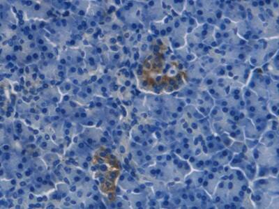 Immunohistochemistry-Paraffin: Endothelin-1 Antibody (C10) [NBP3-41151] - DAB staining on IHC-P; Samples: Human Pancreatic cancer Tissue; Primary Ab: 20ug/ml NBP3-41151; Second Ab: 2ug/mL HRP-Linked Caprine Anti-Mouse IgG Polyclonal Antibody