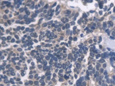 Immunohistochemistry-Paraffin: Endothelin-1 Antibody (C3) [NBP3-41152] - DAB staining on IHC-P; Samples: Human Lung cancer Tissue; Primary Ab: 20ug/ml NBP3-41152