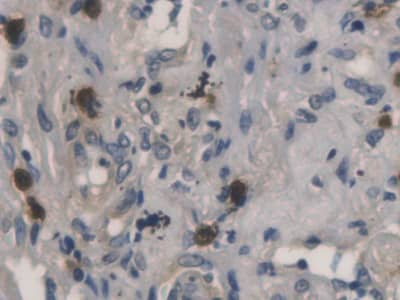 Immunohistochemistry-Paraffin: RNASE3 Antibody (C3) [NBP3-41159] - DAB staining on IHC-P; Samples: Human Lung cancer Tissue