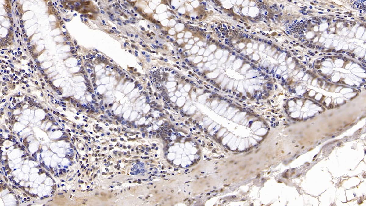 Immunohistochemistry-Paraffin: IGFBP-4 Antibody (C7) [NBP3-41171] - DAB staining on IHC-P; Samples: Human Colon Tissue; Primary Ab: 10ug/ml NBP3-41171; Second Ab: 2ug/mL HRP-Linked Caprine Anti-Mouse IgG Polyclonal Antibody