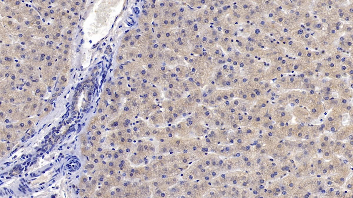 Immunohistochemistry-Paraffin: IGFBP-4 Antibody (C8) [NBP3-41172] - DAB staining on IHC-P; Samples: Human Liver Tissue; Primary Ab: 10ug/ml NBP3-41172; Second Ab: 2ug/mL HRP-Linked Caprine Anti-Mouse IgG Polyclonal Antibody