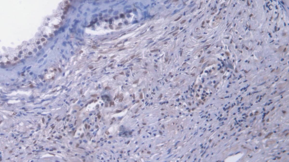 Immunohistochemistry-Paraffin: EGR1 Antibody (C15) [NBP3-41174] - DAB staining on IHC-P; Samples: Human Prostate Tissue; Primary Ab: 20ug/ml NBP3-41174; Second Ab: 2ug/mL HRP-Linked Caprine Anti-Mouse IgG Polyclonal Antibody