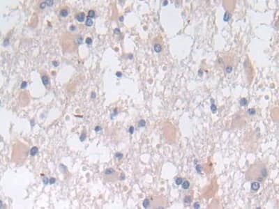 Immunohistochemistry-Paraffin: SNX13 Antibody [NBP3-41236] - DAB staining on IHC-P; Samples: Human Glioma Tissue; Primary Ab: 30ug/ml NBP3-41236; Second Ab: 2ug/mL HRP-Linked Caprine Anti-Rabbit IgG Polyclonal Antibody