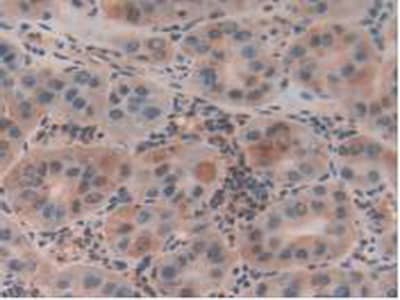 Immunohistochemistry-Paraffin: CLIC1 Antibody [NBP3-41237] - DAB staining on IHC-P; Samples: Human Liver Cancer Tissue.