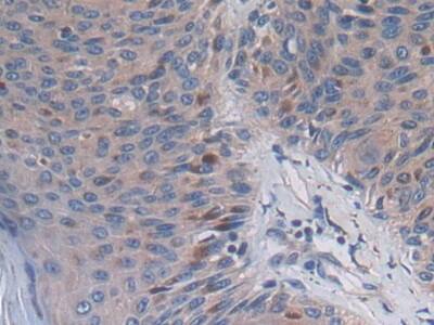 Immunohistochemistry-Paraffin: PC6 Antibody [NBP3-41256] - DAB staining on IHC-P; Samples: Human Skin cancer Tissue; Primary Ab: 30ug/ml NBP3-41256; Second Ab: 2ug/mL HRP-Linked Caprine Anti-Rabbit IgG Polyclonal Antibody