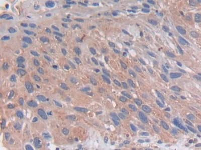 Immunohistochemistry-Paraffin: PC6 Antibody [NBP3-41256] - DAB staining on IHC-P; Samples: Human Lung Tissue; Primary Ab: 30ug/ml NBP3-41256; Second Ab: 2ug/mL HRP-Linked Caprine Anti-Rabbit IgG Polyclonal Antibody