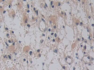 Immunohistochemistry-Paraffin: TMPRSS4 Antibody [NBP3-41268] - DAB staining on IHC-P; Samples: Human Glioma Tissue; Primary Ab: 10ug/ml NBP3-41268; Second Ab: 2ug/mL HRP-Linked Caprine Anti-Rabbit IgG Polyclonal Antibody