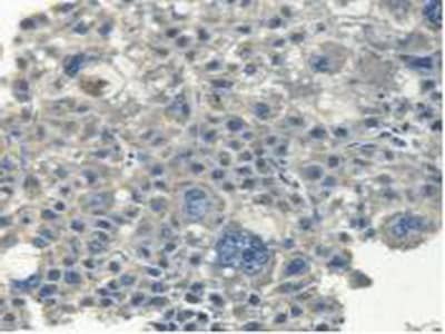 Immunohistochemistry-Paraffin: Myosin heavy chain 14 Antibody [NBP3-41284] - DAB staining on IHC-P; Samples: Human Liver Cancer Tissue.