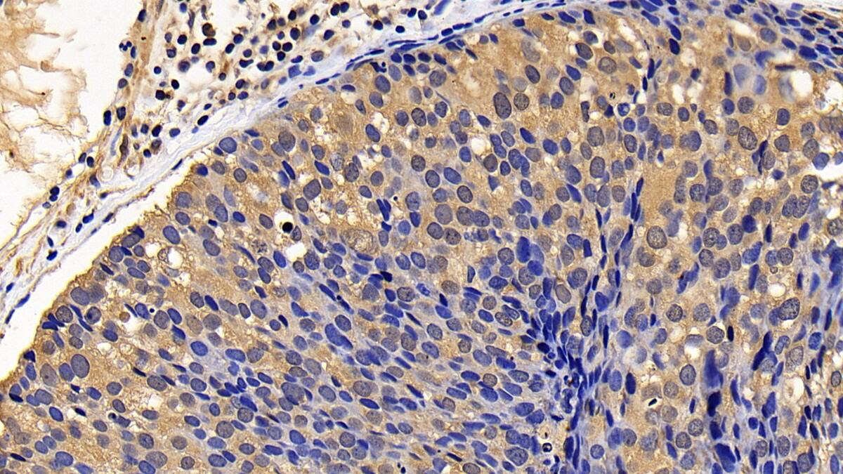 Immunohistochemistry-Paraffin: Blk Antibody [NBP3-41291] - DAB staining on IHC-P; Samples: Human Breast cancer Tissue; Primary Ab: 30ug/ml NBP3-41291; Second Ab: 2ug/mL HRP-Linked Caprine Anti-Rabbit IgG Polyclonal Antibody