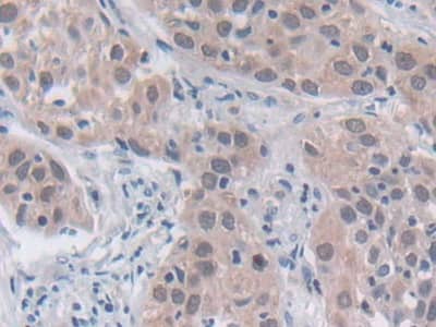 Immunohistochemistry-Paraffin: SRY Antibody [NBP3-41295] - DAB staining on IHC-P; Samples: Human Lung cancer Tissue; Primary Ab: 30ug/ml NBP3-41295; Second Ab: 2ug/mL HRP-Linked Caprine Anti-Rabbit IgG Polyclonal Antibody