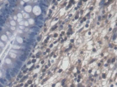 Immunohistochemistry-Paraffin: PLP2 Antibody [NBP3-41299] - DAB staining on IHC-P; Samples: Human Colorectal cancer Tissue; Primary Ab: 20ug/ml NBP3-41299