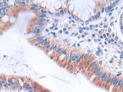 Immunohistochemistry-Paraffin: GLTP Antibody [NBP3-41322] - DAB staining on IHC-P; Samples: Human Stomach cancer Tissue; Primary Ab: 30ug/ml NBP3-41322; Second Ab: 2ug/mL HRP-Linked Caprine Anti-Rabbit IgG Polyclonal Antibody