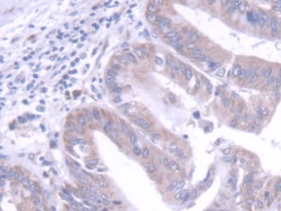 Immunohistochemistry-Paraffin: FGF-20 Antibody [NBP3-41335] - DAB staining on IHC-P; Samples: Human Liver cancer Tissue; Primary Ab: 20ug/ml NBP3-41335