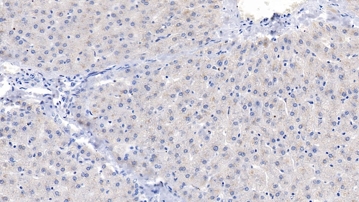 Immunohistochemistry-Paraffin: PLC-delta 3 Antibody [NBP3-41342] - DAB staining on IHC-P; Samples: Human Liver Tissue; Primary Ab: 10ug/ml NBP3-41342; Second Ab: 2ug/mL HRP-Linked Caprine Anti-Rabbit IgG Polyclonal Antibody