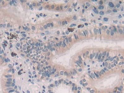 Immunohistochemistry-Paraffin: Persephin Antibody [NBP3-41351] - DAB staining on IHC-P; Samples: Human Lung cancer Tissue; Primary Ab: 30ug/ml NBP3-41351; Second Ab: 2ug/mL HRP-Linked Caprine Anti-Rabbit IgG Polyclonal Antibody