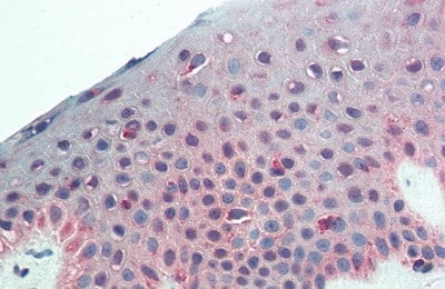 Immunohistochemistry-Paraffin: NG2/MCSP Antibody (6#) [NBP3-41438] - Vector Red staining on IHC-P; Samples: Human Skin Tissue; Primary Ab: 20ug/ml NBP3-41438; Second Ab: 2ug/mL HRP-Linked Caprine Anti-Mouse IgG Monoclonal Antibody