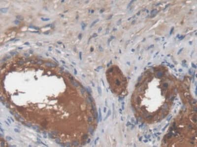 Immunohistochemistry-Paraffin: Galectin-3BP/MAC-2BP/LGALS3BP Antibody (D5) [NBP3-41468] - DAB staining on IHC-P; Samples: Human Prostate Tissue; Primary Ab: 20ug/ml NBP3-41468; Second Ab: 2ug/mL HRP-Linked Caprine Anti-Mouse IgG Polyclonal Antibody