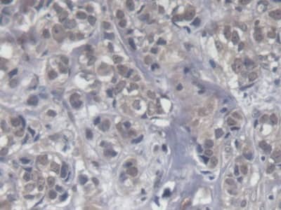 Immunohistochemistry-Paraffin: KIR2DS4/CD158i Antibody (C15) [NBP3-41473] - DAB staining on IHC-P; Samples: Human Breast cancer Tissue; Primary Ab: 20ug/ml NBP3-41473