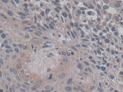 Immunohistochemistry-Paraffin: TGF-beta 3 Antibody (C5) [NBP3-41488] - DAB staining on IHC-P; Samples: Human Lung cancer Tissue; Primary Ab: 20ug/ml NBP3-41488