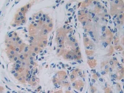 Immunohistochemistry-Paraffin: GHRH Antibody (C2) [NBP3-41494] - DAB staining on IHC-P; Samples: Human Stomach cancer Tissue; Primary Ab: 40ug/ml NBP3-41494; Second Ab: 2ug/mL HRP-Linked Caprine Anti-Mouse IgG Polyclonal Antibody