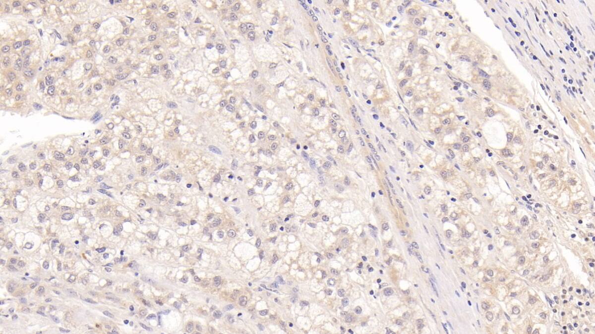 Immunohistochemistry-Paraffin: MBP-1 Antibody (C2) [NBP3-41498] - DAB staining on IHC-P; Samples: Human Liver cancer Tissue; Primary Ab: 20ug/ml NBP3-41498; Second Ab: 2ug/mL HRP-Linked Caprine Anti-Mouse IgG Polyclonal Antibody