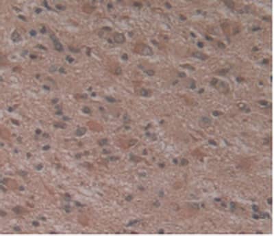 Immunohistochemistry-Paraffin: ATN1 Antibody (C1) [NBP3-41505] - DAB staining on IHC-P; Samples:Human Glioma Tissue.