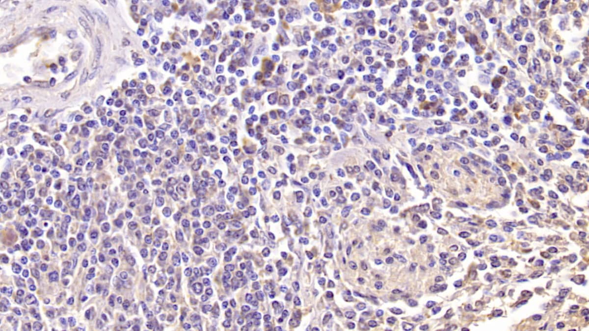 Immunohistochemistry-Paraffin: NKG2D/CD314 Antibody (C1) [NBP3-41507] - DAB staining on IHC-P; Samples: Human Spleen Tissue; Primary Ab: 40ug/ml NBP3-41507; Second Ab: 2ug/mL HRP-Linked Caprine Anti-Mouse IgG Polyclonal Antibody