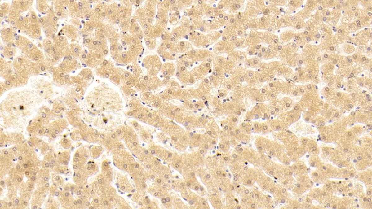 Immunohistochemistry-Paraffin: Complement Component C5a Antibody (D5) [NBP3-41582] - DAB staining on IHC-P; Sample: Human Liver Tissue; Primary Ab: 30ug/ml NBP3-41582; Second Ab: 2ug/mL HRP-Linked Caprine Anti-Mouse IgG Polyclonal Antibody