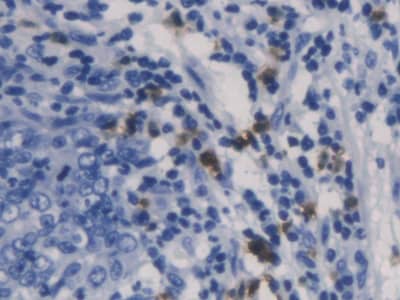 Immunohistochemistry-Paraffin: Galectin-10 Antibody (C2) [NBP3-41588] - DAB staining on IHC-P; Samples: Human Stomach cancer Tissue