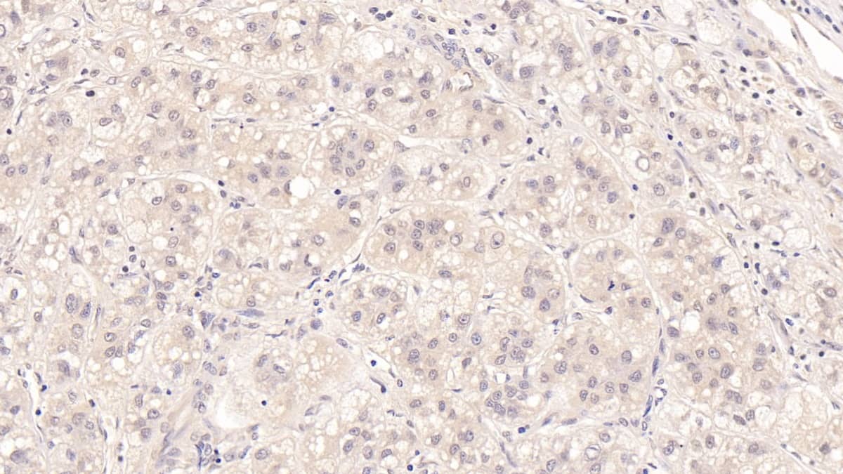 Immunohistochemistry-Paraffin: MBP-1 Antibody (D1) [NBP3-41602] - DAB staining on IHC-P; Sample: Human Liver cancer Tissue; Primary Ab: 20ug/ml NBP3-41602; Second Ab: 2ug/mL HRP-Linked Caprine Anti-Mouse IgG Polyclonal Antibody