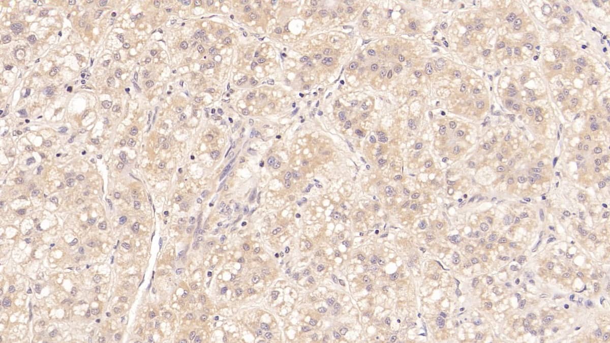 Immunohistochemistry-Paraffin: MBP-1 Antibody (D2) [NBP3-41603] - DAB staining on IHC-P; Sample: Human Liver cancer Tissue; Primary Ab: 20ug/ml NBP3-41603; Second Ab: 2ug/mL HRP-Linked Caprine Anti-Mouse IgG Polyclonal Antibody