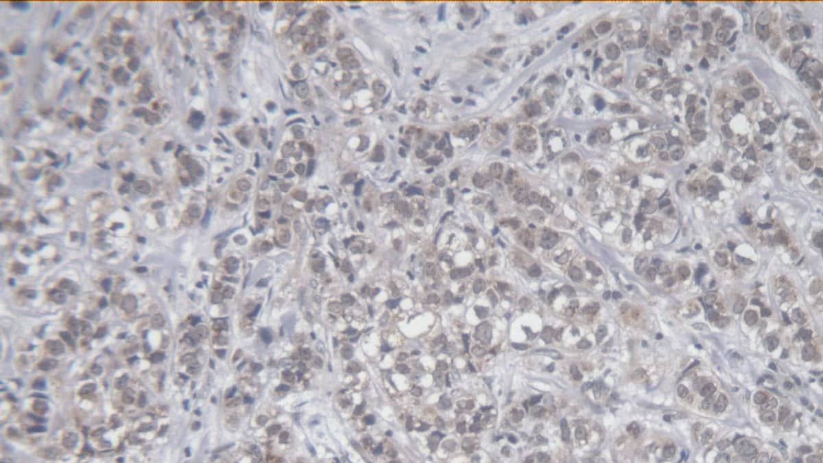 Immunohistochemistry-Paraffin: KIR2DS4/CD158i Antibody (C3) [NBP3-41615] - DAB staining on IHC-P; Sample: Human Breast cancer Tissue; Primary Ab: 20ug/ml NBP3-41615; Second Ab: 2ug/mL HRP-Linked Caprine Anti-Mouse IgG Polyclonal Antibody