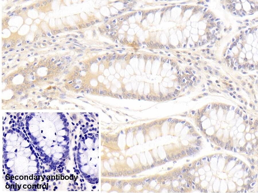 Immunohistochemistry-Paraffin: sFRP-4 Antibody (5#) [NBP3-41642] - DAB staining on IHC-P; Sample: Human Colon Tissue; Primary Ab: 10ug/ml NBP3-41642; Second Ab: 2ug/mL HRP-Linked Caprine Anti-Mouse IgG Polyclonal Antibody