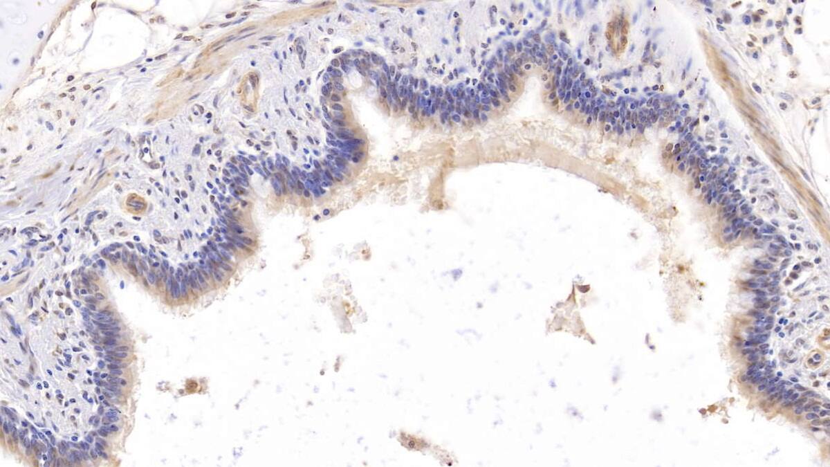 Immunohistochemistry-Paraffin: Collagen VIII alpha 1 Antibody (C3) [NBP3-41722] - DAB staining on IHC-P; Samples: Human Lung Tissue; Primary Ab: 10ug/ml NBP3-41722; Second Ab: 2ug/mL HRP-Linked Caprine Anti-Mouse IgG Polyclonal Antibody