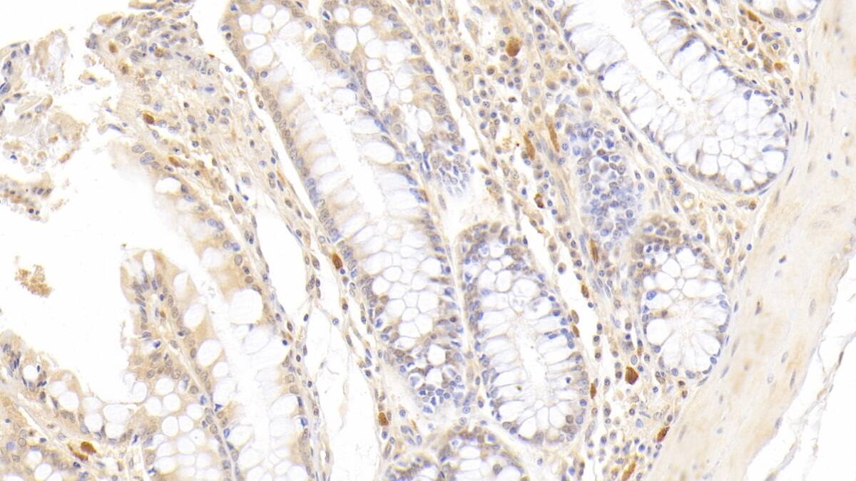 Immunohistochemistry-Paraffin: Eosinophil derived neurotoxin Antibody (C13) [NBP3-41747] - DAB staining on IHC-P; Sample: Human Colon Tissue; Primary Ab: 20ug/ml NBP3-41747; Second Ab: 2ug/mL HRP-Linked Caprine Anti-Mouse IgG Polyclonal Antibody