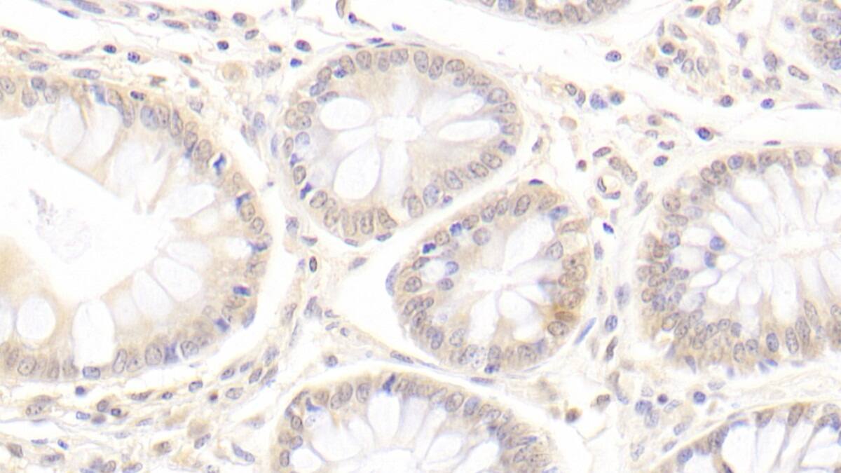 Immunohistochemistry-Paraffin: epithelial Sodium Channel gamma Antibody (C1) [NBP3-41759] - DAB staining on IHC-P; Sample: Human Colon Tissue; Primary Ab: 20ug/ml NBP3-41759; Second Ab: 2ug/mL HRP-Linked Caprine Anti-Mouse IgG Polyclonal Antibody