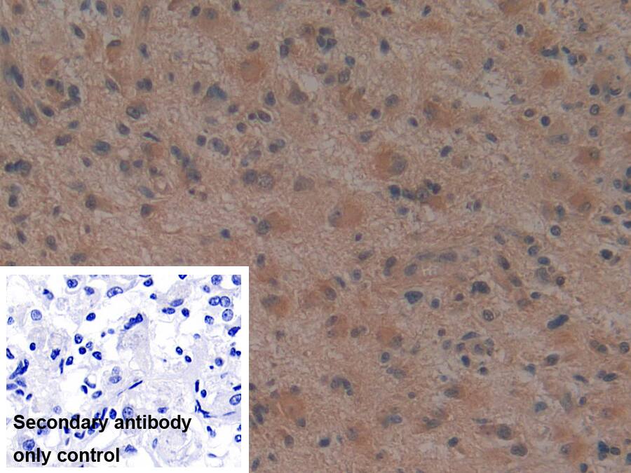 Immunohistochemistry-Paraffin: Noggin Antibody (A7) [NBP3-41763] - DAB staining on IHC-P; Sample: Human Glioma Tissue; Primary Ab: 30ug/ml NBP3-41763; Second Ab: 2ug/mL HRP-Linked Caprine Anti-Mouse IgG Polyclonal Antibody