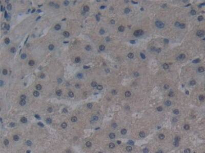 Immunohistochemistry-Paraffin: Noggin Antibody (A11) [NBP3-41764] - DAB staining on IHC-P; Sample: Human Liver cancer Tissue; Primary Ab: 30ug/ml NBP3-41764; Second Ab: 2ug/mL HRP-Linked Caprine Anti-Mouse IgG Polyclonal Antibody