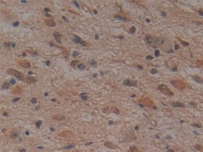 Immunohistochemistry-Paraffin: Noggin Antibody (A9) [NBP3-41765] - DAB staining on IHC-P; Samples: Human Glioma Tissue; Primary Ab: 30ug/ml NBP3-41765; Second Ab: 2ug/mL HRP-Linked Caprine Anti-Mouse IgG Polyclonal Antibody