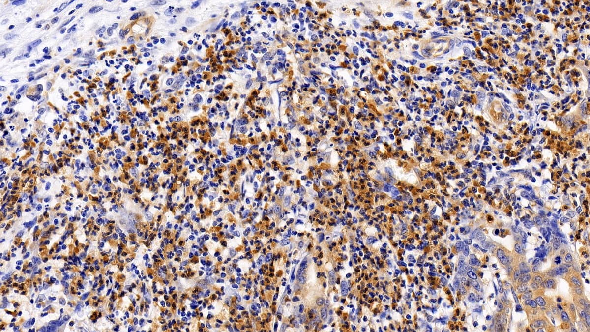 Immunohistochemistry-Paraffin: RGS19 Antibody [NBP3-41987] - DAB staining on IHC-P; Sample: Human Stomach cancer Tissue; Primary Ab: 10ug/ml NBP3-41987; Second Ab: 2ug/mL HRP-Linked Caprine Anti-Rabbit IgG Polyclonal Antibody