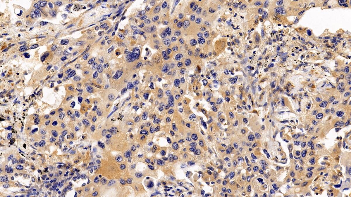 Immunohistochemistry-Paraffin: RGS19 Antibody [NBP3-41987] - DAB staining on IHC-P; Sample: Human Lung cancer Tissue; Primary Ab: 10ug/ml NBP3-41987; Second Ab: 2ug/mL HRP-Linked Caprine Anti-Rabbit IgG Polyclonal Antibody